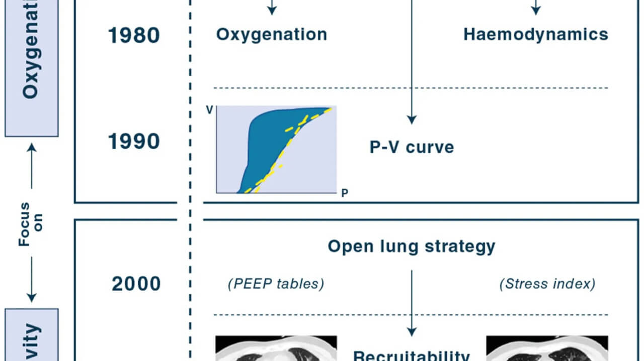 In search of the Holy Grail: identifying the best PEEP in ventilated ...