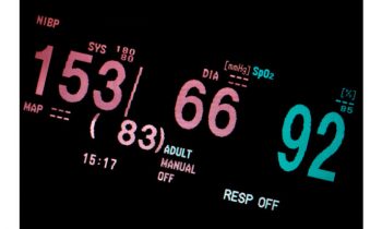 Mean arterial pressure during cardiopulmonary bypass: A modifiable risk factor for acute kidney injury in cardiac surgery patients?