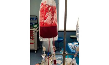 Increased platelet to red blood cell transfusion ratio associated with acute kidney injury in children with life-threatening bleeding