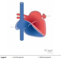 Situs solitus with left and right atrial appendices