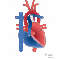 Aberrant left pulmonary artery