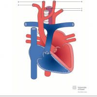 Aberrant left subclavian artery