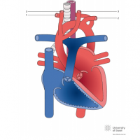 Aberrant right subclavian artery