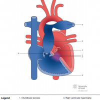 Absent pulmonary valve syndrom