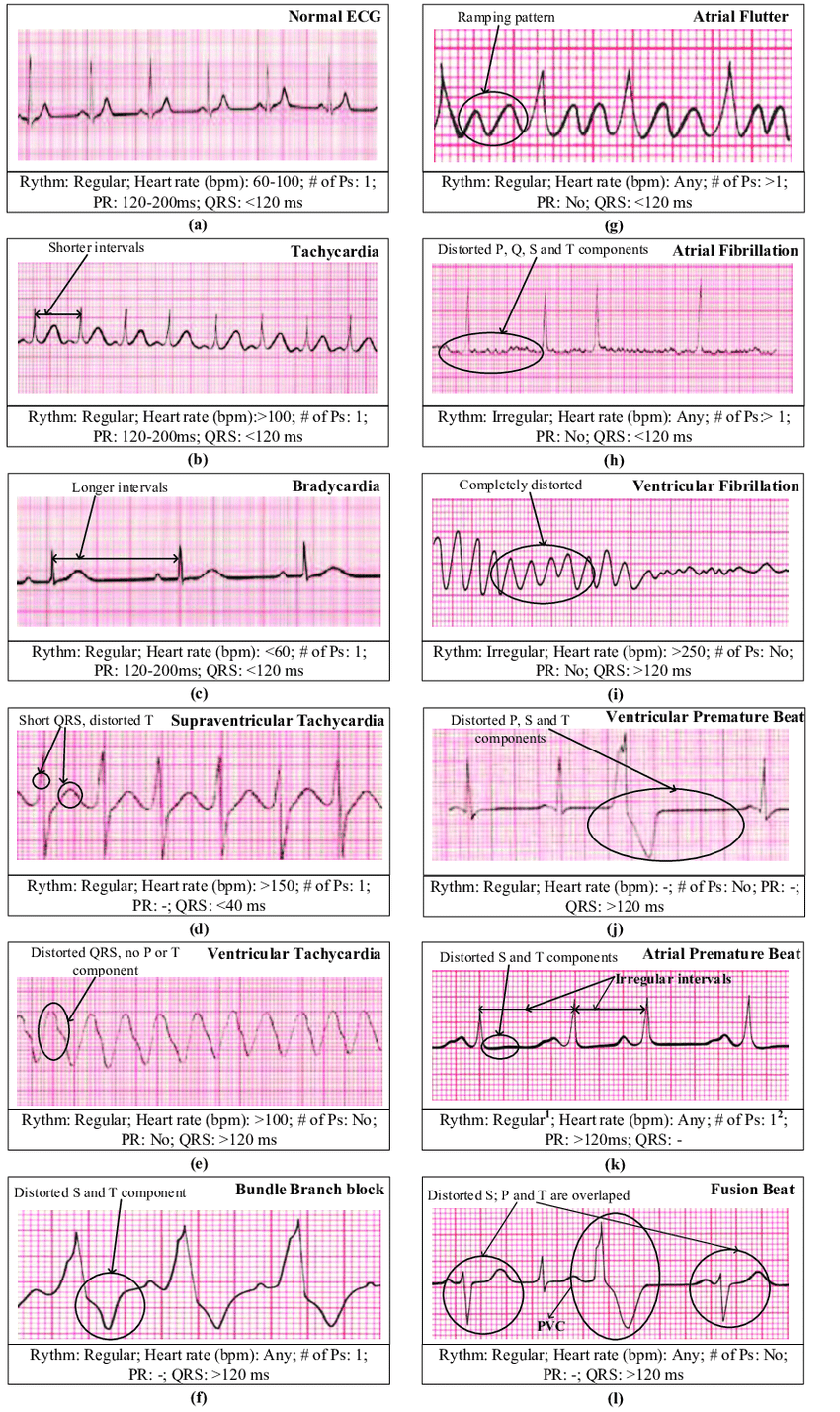 An-illustrative-description-of-different-arrhythmias-Thaler-2015-a-normal-ECG-b