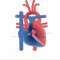 Anomalous left coronary artery from the pulmonary artery (ALCAPA)
