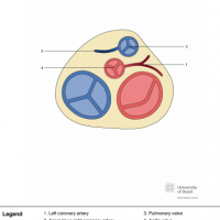 Anomalous right coronary artery from the pulmonary artery (ARCAPA)