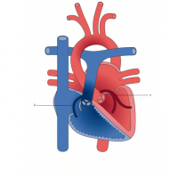 Anomalous left coronary artery from the pulmonary artery (ALCAPA); short axis