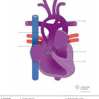 Aortic atresia and hypoplastic left ventricle