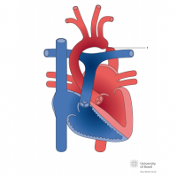 Aortic coarctation; focal type