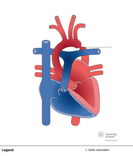 Aortic coarctation; focal type