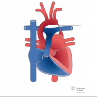 Aortic coarctation; tubular type