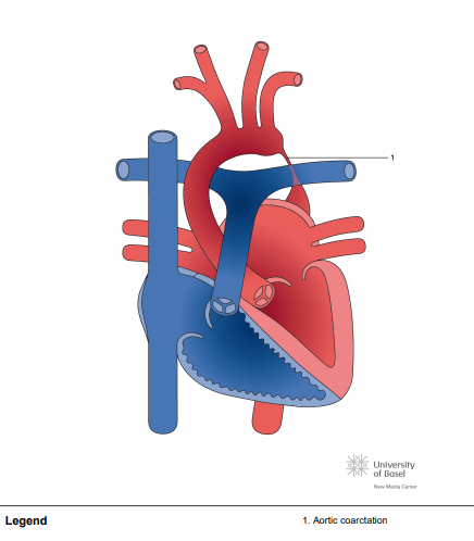Aortic coarctation; tubular type