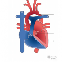 Aortic coarctation with biscuspid aortic valve