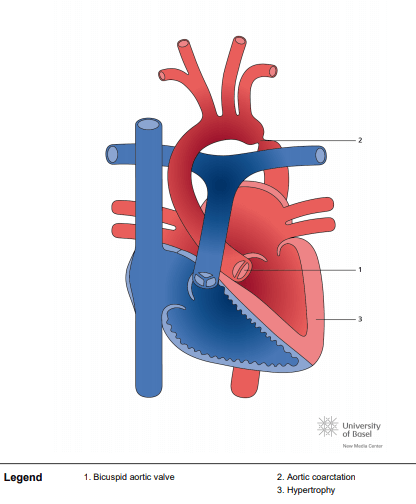Aortic coarctation with biscuspid aortic valve