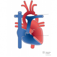 Aortic coarctation with ventricular septal defect (VSD)