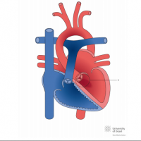 Aortic regurgitation