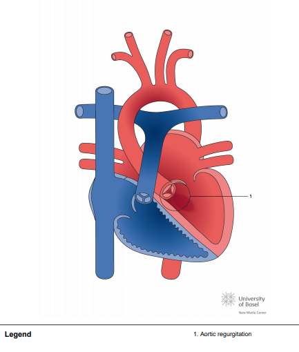 Aortic regurgitation