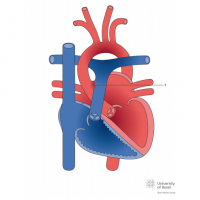 Aortopulmonary window