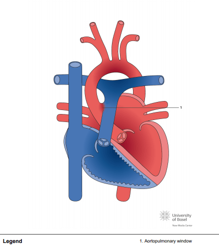 Aortopulmonary window
