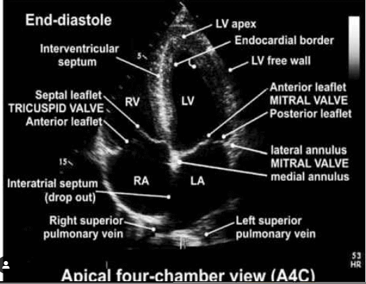 Apical four chamber view “A4C”