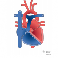 Atrial septal defect (ASD) Type II