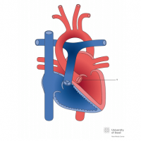 Bicuspid aortic valve