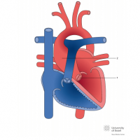 Bicuspid aortic valve with aorta ascending aneurysma