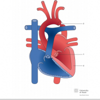 Bicuspid aortic valve with aortic coarctation