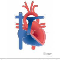 Bicuspid aortic valve with aortic regurgitation