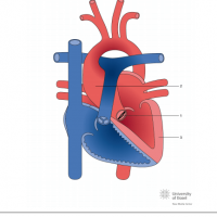 Bicuspid aortic valve with aortic stenosis and aorta ascending aneurysma