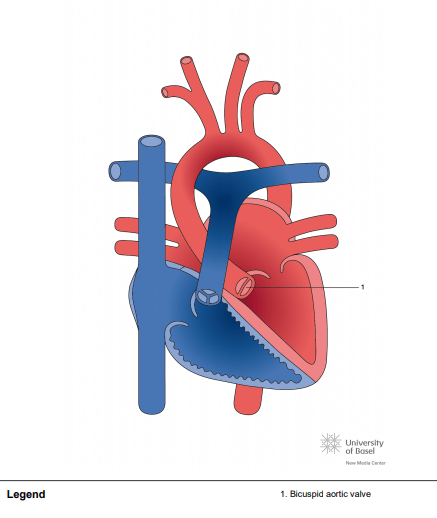 Bicuspid aortic valve