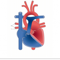 Superior sinus venosus defect (SVD) with partial anomalous pulmonary venous connection (PAPVC)
