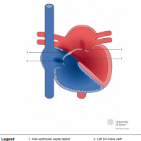 Complete atrioventricular septal defect (AVSD)