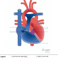 Complete atrioventricular septal defect (AVSD) with tetralogy of Fallot