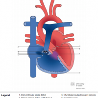 Complete atrioventricular septal defect (AVSD) with tetralogy of Fallot and pulmonary stenosis