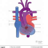 Concordant criss cross AV connection, VSD and double outlet right ventricle (DORV)