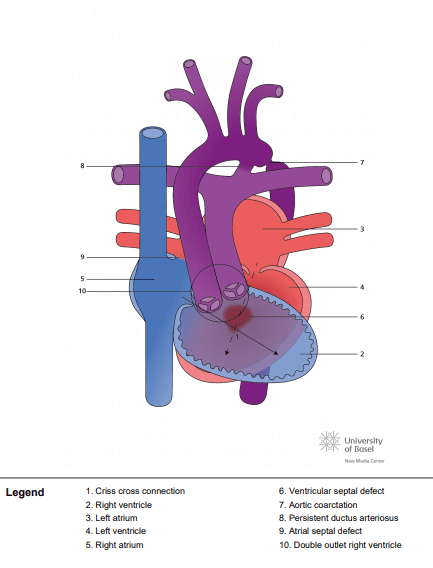 Concordant criss cross AV connection, VSD and double outlet right ventricle (DORV)