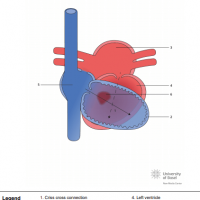 Concordant criss cross AV connection with ventricular septal defect (VSD)