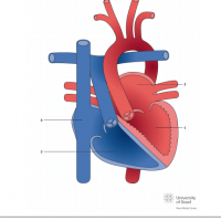 Congenitally corrected transposition of the great arteries (ccTGA)