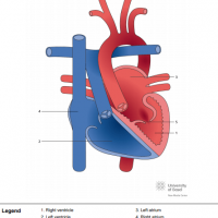 Congenitally corrected transposition of the great arteries (ccTGA) with Ebstein-like tricuspid valve