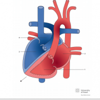 Congenitally corrected transposition of the great arteries (ccTGA) with dextrocardia