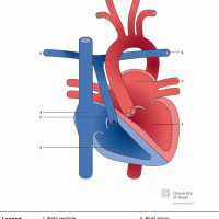 Congenitally corrected transposition of the great arteries (ccTGA) with pulmonary atresia