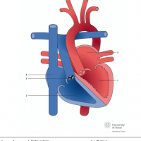 Congenitally corrected transposition of the great arteries (ccTGA) with pulmonary stenosis