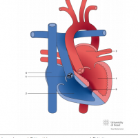 Congenitally corrected transposition of the great arteries (ccTGA) with pulmonary stenosis and VSD