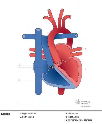 Congenitally corrected transposition of the great arteries (ccTGA) with pulmonary stenosis