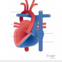 Congenitally corrected transposition of the great arteries (ccTGA) with situs inversus