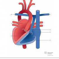 Congenitally corrected transposition of the great arteries (ccTGA) with situs inversus and pulmonary atresia