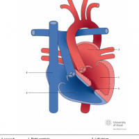 Congenitally corrected transposition of the great arteries (ccTGA) with ventricular septal defect (VSD)