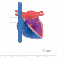 Cor triatriatum sinister with complete membrane and atrial septal defect (ASD) with right-to-left shunt